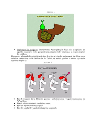 FIGURA 5



Intervención de excepción: esfinterotomía. Aconsejada por Roux, solo es aplicable en
aquellos casos raros en los que existe una estrechez real y efectiva de la porción inferior
del colédoco.
Finalmente, adaptando los principios tácticos descritos a todas las variantes de las dilataciones
quísticas establecidas en la clasificación de Todani, es posible precisar la táctica operatoria
siguiente (Figura 6):
FIGURA 6






Tipo I: resección de la dilatación quística + colecistectomía + hepatoyeyunostomía en
"Y" de Roux.
Tipo II: diverticulectomía + colecistectomía.
Tipo III: papilotomía endoscópica.
Tipo IV: igual al I + hepatectomía parcial (eventual).

 