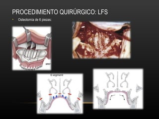 PROCEDIMIENTO QUIRÚRGICO: LFS
• Osteotomía de 6 piezas:
 