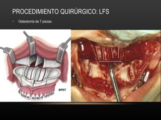 PROCEDIMIENTO QUIRÚRGICO: LFS
• Osteotomía de 7 piezas:
 