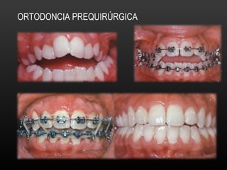 ORTODONCIA PREQUIRÚRGICA
 