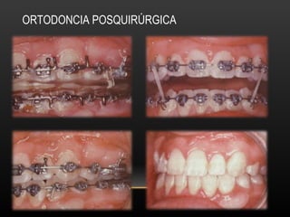 ORTODONCIA POSQUIRÚRGICA
 