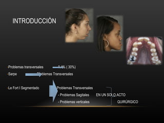 INTRODUCCIÓN
-Problemas transversales 9,4% ( 30%)
-Sarpe Problemas Transversales
-Le Fort I Segmentado - Problemas Transversales
- Problemas Sagitales EN UN SOLO ACTO
- Problemas verticales QUIRÚRGICO
 