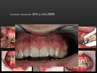 • Cortisicion. Piezosicion. (Kim y cols.2009)
 