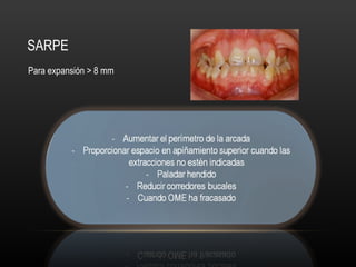 SARPE
Para expansión > 8 mm
 