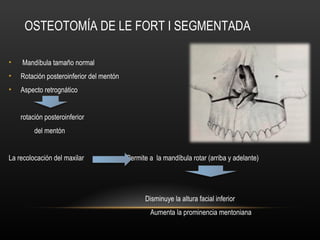OSTEOTOMÍA DE LE FORT I SEGMENTADA
• Mandíbula tamaño normal
• Rotación posteroinferior del mentón
• Aspecto retrognático
rotación posteroinferior
del mentón
La recolocación del maxilar Permite a la mandíbula rotar (arriba y adelante)
Disminuye la altura facial inferior
Aumenta la prominencia mentoniana
 
