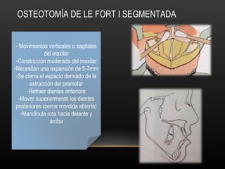 OSTEOTOMÍA DE LE FORT I SEGMENTADA
- Movimientos verticales o sagitales
del maxilar
-Constricción moderada del maxilar
-Necesitan una expansión de 5-7mm
-Se cierra el espacio derivado de la
extracción del premolar
-Retraer dientes anteriore
-Mover superiormente los dientes
posteriores (cerrar mordida abierta)
-Mandíbula rota hacia delante y
arriba
 