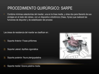 PROCEDIMIENTO QUIRÚRGICO: SARPE
• Combina mínimas osteotomías del maxilar, una en la línea media, y otras dos para liberarlo de sus
anclajes en el resto del cráneo, con un dispositivo ortodóncico (Haas, Hyrax) que realizará las
funciones de disyuntor y de estabilizador del proceso
Las áreas de resistencia del maxilar se clasifican en :
1) Soporte Anterior: Fosas piriformes
2) Soporte Lateral: Apófisis cigomática
3) Soporte posterior: fisura pterigopalatina
4) Soporte medial: Sutura palatina media
 