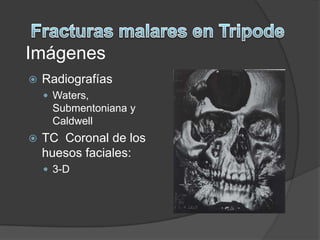 Fracturasmalares en TripodeImágenesRadiografíasWaters, Submentoniana y CaldwellTC  Coronal de los huesosfaciales:3-D