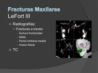 FracturasMaxilaresLeFort IIIRadiografías:Fracturas a través:SurturafrontomalarMalarPared orbitaria medialHueso NasalTC 