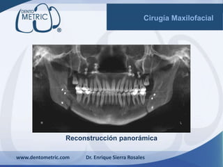 Reconstrucción panorámica
www.dentometric.com Dr. Enrique Sierra Rosales
Cirugía Maxilofacial
 