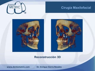 www.dentometric.com Dr. Enrique Sierra Rosales
Reconstrucción 3D
Cirugía Maxilofacial
 