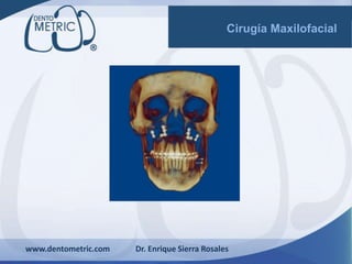 www.dentometric.com Dr. Enrique Sierra Rosales
Cirugía Maxilofacial
 