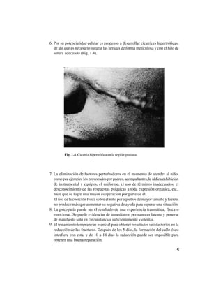 5
6. Por su potencialidad celular es propenso a desarrollar cicatrices hipertróficas,
de ahí que es necesario suturar las heridas de forma meticulosa y con el hilo de
sutura adecuado (Fig. 1.4).
Fig. 1.4. Cicatriz hipertrófica en la región geniana.
7. La eliminación de factores perturbadores en el momento de atender al niño,
como por ejemplo: los provocados por padres, acompañantes, la sádica exhibición
de instrumental y equipos, el uniforme, el uso de términos inadecuados, el
desconocimiento de las respuestas psíquicas a toda expresión orgánica, etc.,
hace que se logre una mayor cooperación por parte de él.
El uso de la coerción física sobre el niño por aquellos de mayor tamaño y fuerza,
no produce más que aumentar su negativa de ayuda para superar una situación.
8. La psicopatía puede ser el resultado de una experiencia traumática, física o
emocional. Se puede evidenciar de inmediato o permanecer latente y ponerse
de manifiesto solo en circunstancias suficientemente violentas.
9. El tratamiento temprano es esencial para obtener resultados satisfactorios en la
reducción de las fracturas. Después de los 5 días, la formación del callo óseo
interfiere con esta, y de 10 a 14 días la reducción puede ser imposible para
obtener una buena reparación.
 