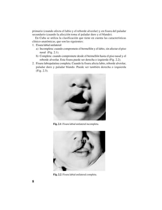 8
primario (cuando afecta el labio y el reborde alveolar) y en fisura del paladar
secundario (cuando la afección toma el paladar duro y el blando).
En Cuba se utiliza la clasificación que tiene en cuenta las características
clínico-anatómicas, que son las siguientes:
1. Fisura labial unilateral:
a) Incompleta: cuando compromete el bermellón y el labio, sin afectar el piso
nasal (Fig. 2.1).
b) Completa: cuando compromete desde el bermellón hasta el piso nasal y el
reborde alveolar. Esta fisura puede ser derecha o izquierda (Fig. 2.2).
2. Fisura labiopalatina completa. Cuando la fisura afecta labio, reborde alveolar,
paladar duro y paladar blando. Puede ser también derecha o izquierda
(Fig. 2.3).
Fig. 2.1. Fisura labial unilateral incompleta.
Fig. 2.2. Fisura labial unilateral completa.
 