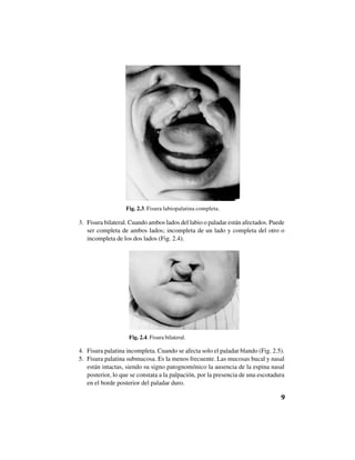 9
3. Fisura bilateral. Cuando ambos lados del labio o paladar están afectados. Puede
ser completa de ambos lados; incompleta de un lado y completa del otro o
incompleta de los dos lados (Fig. 2.4).
4. Fisura palatina incompleta. Cuando se afecta solo el paladar blando (Fig. 2.5).
5. Fisura palatina submucosa. Es la menos frecuente. Las mucosas bucal y nasal
están intactas, siendo su signo patognomónico la ausencia de la espina nasal
posterior, lo que se constata a la palpación, por la presencia de una escotadura
en el borde posterior del paladar duro.
Fig. 2.4. Fisura bilateral.
Fig. 2.3. Fisura labiopalatina completa.
 