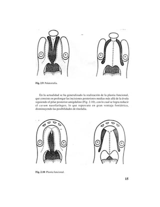 15
Fig. 2.9. Palatorrafia.
En la actualidad se ha generalizado la realización de la plastia funcional,
que consiste en prolongar las incisiones posteriores medias más allá de la úvula
siguiendo el pilar posterior amigdalino (Fig. 2.10), con lo cual se logra reducir
el cavum nasofaríngeo, lo que repercute en gran ventaja foniátrica,
disminuyendo las posibilidades de rinolalia.
Fig. 2.10. Plastia funcional.
 