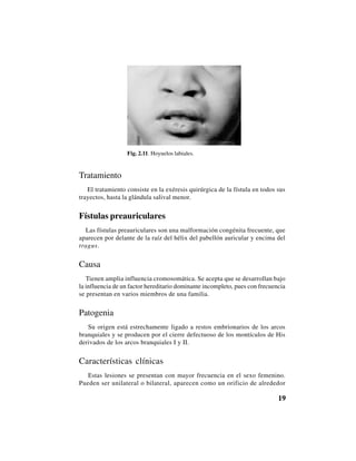19
Fig. 2.11. Hoyuelos labiales.
Tratamiento
El tratamiento consiste en la exéresis quirúrgica de la fístula en todos sus
trayectos, hasta la glándula salival menor.
Fístulas preauriculares
Las fístulas preauriculares son una malformación congénita frecuente, que
aparecen por delante de la raíz del hélix del pabellón auricular y encima del
tragus.
Causa
Tienen amplia influencia cromosomática. Se acepta que se desarrollan bajo
la influencia de un factor hereditario dominante incompleto, pues con frecuencia
se presentan en varios miembros de una familia.
Patogenia
Su origen está estrechamente ligado a restos embrionarios de los arcos
branquiales y se producen por el cierre defectuoso de los montículos de His
derivados de los arcos branquiales I y II.
Características clínicas
Estas lesiones se presentan con mayor frecuencia en el sexo femenino.
Pueden ser unilateral o bilateral, aparecen como un orificio de alrededor
 