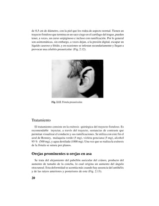 20
de 0,5 cm de diámetro, con la piel que los rodea de aspecto normal. Tienen un
trayecto fistuloso que termina en un saco ciego en el cartílago del tragus, pueden
tener, a veces, un curso serpiginoso e incluso con ramificación. Por lo general
son asintomáticas, sin embargo, a veces dejan, a la presión digital, escapar un
líquido caseoso y fétido, y en ocasiones se infestan secundariamente y llegan a
provocar una celulitis preauricular (Fig. 2.12).
Fig. 2.12. Fístula preauricular.
Tratamiento
El tratamiento consiste en la exéresis quirúrgica del trayecto fistuloso. Es
recomendable inyectar, a través del trayecto, sustancias de contraste que
permitan visualizar el conducto y sus ramificaciones. Se utiliza con este fin el
azul de Bonney, malaquita verde (5 mg), violeta genciana (5 mg), alcohol
95 % (500 mg), y agua destilada (1000 mg). Una vez que se realiza la exéresis
de la fístula se sutura por planos.
Orejas prominentes u orejas en asa
Se trata del alejamiento del pabellón auricular del cráneo, producto del
aumento de tamaño de la concha, lo cual origina un aumento del ángulo
otocraneal. Esta deformidad se acentúa más cuando hay ausencia del antihélix
y de las raíces anteriores y posteriores de este (Fig. 2.13).
 