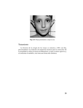 21
Fig. 2.13. Orejas prominentes u orejas en asa.
Tratamiento
La historia de la cirugía de las orejas se remonta a 1881 con Ely,
preconizándose su evolución con numerosas técnicas para la corrección. En
la actualidad se utiliza la técnica de Monasterio, ya que es menos agresiva y,
al conformar el antihélix, este toma una forma más armónica.
 