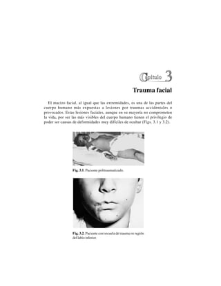 22
Trauma facial
El macizo facial, al igual que las extremidades, es una de las partes del
cuerpo humano más expuestas a lesiones por traumas accidentales o
provocados. Estas lesiones faciales, aunque en su mayoría no comprometen
la vida, por ser las más visibles del cuerpo humano tienen el privilegio de
poder ser causas de deformidades muy difíciles de ocultar (Figs. 3.1 y 3.2).
Fig. 3.1. Paciente politraumatizado.
Fig. 3.2. Paciente con secuela de trauma en región
del labio inferior.
 