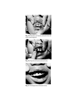 26
Fig. 3.5. Paciente con fractura dentoalveolar del
sector anterosuperior.
Fig. 3.6. Fijación de fractura dentoalveolar.
Fig. 3.7. Prolongación de férula de resina.
 