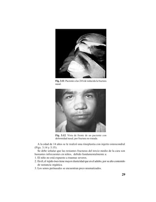 29
Fig. 3.11. Paciente a las 24 h de reducida la fractura
nasal.
Fig. 3.12. Vista de frente de un paciente con
deformidad nasal, por fractura no tratada.
A la edad de 14 años se le realizó una rinoplastia con injerto osteocondral
(Figs. 3.14 y 3.15).
Se debe señalar que las restantes fracturas del tercio medio de la cara son
bastantes infrecuentes en niños, debido fundamentalmente a:
1. El niño no está expuesto a traumas severos.
2. En él, el tejido óseo tiene mayor elasticidad que en el adulto, por su alto contenido
de sustancia orgánica.
3. Los senos perinasales se encuentran poco neumatizados.
 