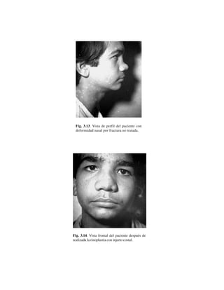30
Fig. 3.13. Vista de perfil del paciente con
deformidad nasal por fractura no tratada.
Fig. 3.14. Vista frontal del paciente después de
realizada la rinoplastia con injerto costal.
 