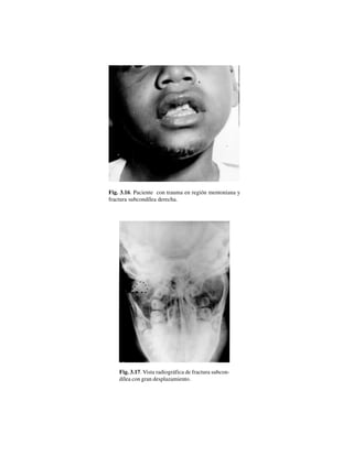 32
Fig. 3.16. Paciente con trauma en región mentoniana y
fractura subcondílea derecha.
Fig. 3.17. Vista radiográfica de fractura subcon-
dílea con gran desplazamiento.
 