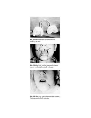 34
Fig. 3.19. Férula fenestrada mandibular y
modelos de yeso.
Fig. 3.20. Paciente con fractura mandibular de
cuerpo con férula fenestrada colocada.
Fig. 3.21. Paciente con herida en región geniana y
fractura mandibular desplazada.
 