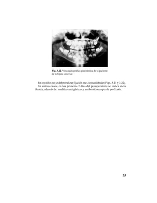 35
En los niños no se debe realizar fijación maxilomandibular (Figs. 3.21 y 3.22).
En ambos casos, en los primeros 7 días del posoperatorio se indica dieta
blanda, además de medidas analgésicas y antibioticoterapia de profilaxis.
Fig. 3.22. Vista radiográfica panorámica de la paciente
de la figura anterior.
 