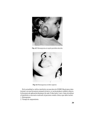 39
Fig. 4.3. Hemangioma en región parotídea derecha.
Fig. 4.4. Hemangioma en labio superior.
En la actualidad se utiliza interferón con una dosis de 20 000 U/kg de peso intra-
lesional, con una frecuencia semanal (al inicio, se van ha producir cambios clínicos,
la frecuencia de aplicación disminuye de cada 15 días hasta 1 mes).Antes de utilizar
el interferón es necesario realizarle al paciente estudio clínico que debe incluir:
1. Hemograma.
2. Tiempo de sangramiento.
 