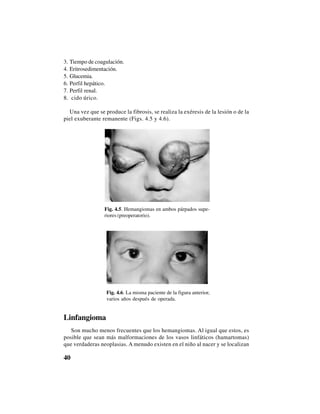 40
3. Tiempo de coagulación.
4. Eritrosedimentación.
5. Glucemia.
6. Perfil hepático.
7. Perfil renal.
8. Ácido úrico.
Una vez que se produce la fibrosis, se realiza la exéresis de la lesión o de la
piel exuberante remanente (Figs. 4.5 y 4.6).
Fig. 4.5. Hemangiomas en ambos párpados supe-
riores (preoperatorio).
Fig. 4.6. La misma paciente de la figura anterior,
varios años después de operada.
Linfangioma
Son mucho menos frecuentes que los hemangiomas. Al igual que estos, es
posible que sean más malformaciones de los vasos linfáticos (hamartomas)
que verdaderas neoplasias. A menudo existen en el niño al nacer y se localizan
 