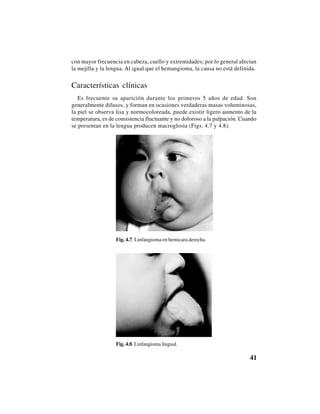 41
con mayor frecuencia en cabeza, cuello y extremidades; por lo general afectan
la mejilla y la lengua. Al igual que el hemangioma, la causa no está definida.
Características clínicas
Es frecuente su aparición durante los primeros 5 años de edad. Son
generalmente difusos, y forman en ocasiones verdaderas masas voluminosas,
la piel se observa lisa y normocoloreada, puede existir ligero aumento de la
temperatura, es de consistencia fluctuante y no doloroso a la palpación. Cuando
se presentan en la lengua producen macroglosia (Figs. 4.7 y 4.8).
Fig. 4.7. Linfangioma en hemicara derecha.
Fig. 4.8. Linfangioma lingual.
 