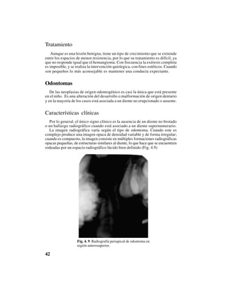 42
Tratamiento
Aunque es una lesión benigna, tiene un tipo de crecimiento que se extiende
entre los espacios de menor resistencia, por lo que su tratamiento es difícil, ya
que no responde igual que el hemangioma. Con frecuencia la exéresis completa
es imposible, y se realiza la intervención quirúrgica, con fines estéticos. Cuando
son pequeños lo más aconsejable es mantener una conducta expectante.
Odontomas
De las neoplasias de origen odontogénico es casi la única que está presente
en el niño. Es una alteración del desarrollo o malformación de origen dentario
y en la mayoría de los casos está asociada a un diente no erupcionado o ausente.
Características clínicas
Por lo general, el único signo clínico es la ausencia de un diente no brotado
o un hallazgo radiográfico cuando está asociado a un diente supernumerario.
La imagen radiográfica varía según el tipo de odontoma. Cuando este es
complejo produce una imagen opaca de densidad variable y de forma irregular;
cuando es compuesto, la imagen consiste en múltiples formaciones radiográficas
opacas pequeñas, de estructuras similares al diente, lo que hace que se encuentren
rodeadas por un espacio radiográfico lúcido bien definido (Fig. 4.9)
Fig. 4. 9. Radiografía periapical de odontoma en
región anterosuperior.
 