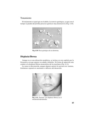 43
Tratamiento
El tratamiento es igual que en el adulto, la exéresis quirúrgica, ya que con el
tiempo se pueden desarrollar procesos quísticos muy destructivos (Fig. 4.10).
Fig. 4.10. Pieza quirúrgica de un odontoma.
Displasia fibrosa
Aunque no es una alteración neoplásica, se incluye en este capítulo por la
frecuencia con que aparece en edades infantiles. Su forma de aparición más
común es la displasia fibrosa monostótica de los maxilares (Fig. 4.11).
La causa es desconocida, aunque algunos autores la asocian con: traumas,
fenómenos reparativos anormales o defectos del desarrollo.
Fig. 4.11. Paciente con displasia fibrosa en el
maxilar del lado derecho.
 