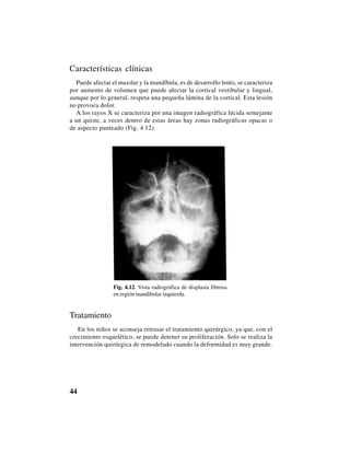 44
Características clínicas
Puede afectar el maxilar y la mandíbula, es de desarrollo lento, se caracteriza
por aumento de volumen que puede afectar la cortical vestibular y lingual,
aunque por lo general, respeta una pequeña lámina de la cortical. Esta lesión
no provoca dolor.
A los rayos X se caracteriza por una imagen radiográfica lúcida semejante
a un quiste, a veces dentro de estas áreas hay zonas radiográficas opacas o
de aspecto punteado (Fig. 4.12).
Fig. 4.12. Vista radiográfica de displasia fibrosa
en región mandibular izquierda.
Tratamiento
En los niños se aconseja retrasar el tratamiento quirúrgico, ya que, con el
crecimiento esquelético, se puede detener su proliferación. Solo se realiza la
intervención quirúrgica de remodelado cuando la deformidad es muy grande.
 