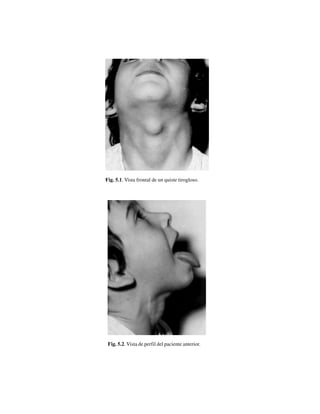 46
Fig. 5.1. Vista frontal de un quiste tirogloso.
Fig. 5.2. Vista de perfil del paciente anterior.
 