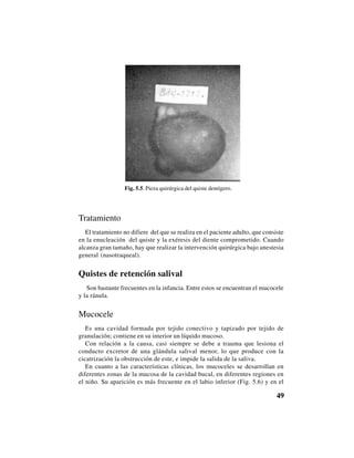 49
Fig. 5.5. Pieza quirúrgica del quiste dentígero.
Tratamiento
El tratamiento no difiere del que se realiza en el paciente adulto, que consiste
en la enucleación del quiste y la exéresis del diente comprometido. Cuando
alcanza gran tamaño, hay que realizar la intervención quirúrgica bajo anestesia
general (nasotraqueal).
Quistes de retención salival
Son bastante frecuentes en la infancia. Entre estos se encuentran el mucocele
y la ránula.
Mucocele
Es una cavidad formada por tejido conectivo y tapizado por tejido de
granulación; contiene en su interior un líquido mucoso.
Con relación a la causa, casi siempre se debe a trauma que lesiona el
conducto excretor de una glándula salival menor, lo que produce con la
cicatrización la obstrucción de este, e impide la salida de la saliva.
En cuanto a las características clínicas, los mucoceles se desarrollan en
diferentes zonas de la mucosa de la cavidad bucal, en diferentes regiones en
el niño. Su aparición es más frecuente en el labio inferior (Fig. 5.6) y en el
 