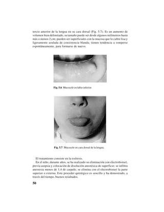 50
tercio anterior de la lengua en su cara dorsal (Fig. 5.7). Es un aumento de
volumen bien delimitado, su tamaño puede ser desde algunos milímetros hasta
más o menos 2 cm; pueden ser superficiales con la mucosa que lo cubre lisa y
ligeramente azulada de consistencia blanda; tienen tendencia a romperse
espontáneamente, para formarse de nuevo.
Fig. 5.6. Mucocele en labio inferior.
Fig. 5.7. Mucocele en cara dorsal de la lengua.
El tratamiento consiste en la exéresis.
En el niño, durante años, se ha realizado su eliminación con electrobisturí,
previa asepsia y colocación de disolución anestésica de superficie; se infiltra
anestesia menos de 1,4 de carpule; se elimina con el electrobisturí la parte
superior o externa. Este proceder quirúrgico es sencillo y ha demostrado, a
través del tiempo, buenos resultados.
 