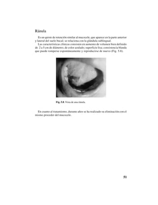 51
Ránula
Es un quiste de retención similar al mucocele, que aparece en la parte anterior
y lateral del suelo bucal; se relaciona con la glándula sublingual.
Las características clínicas consisten en aumento de volumen bien definido
de 2 a 5 cm de diámetro; de color azulado; superficie lisa; consistencia blanda
que puede romperse espontáneamente y reproducirse de nuevo (Fig. 5.8).
Fig. 5.8. Vista de una ránula.
En cuanto al tratamiento, durante años se ha realizado su eliminación con el
mismo proceder del mucocele.
 