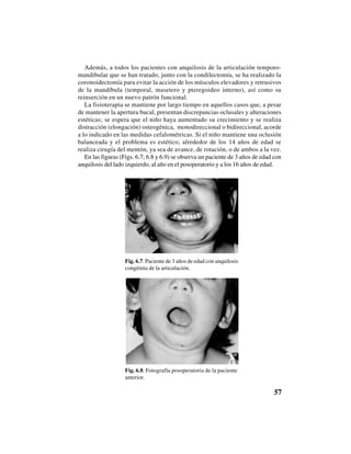 57
Además, a todos los pacientes con anquilosis de la articulación temporo-
mandibular que se han tratado, junto con la condilectomía, se ha realizado la
coronoidectomía para evitar la acción de los músculos elevadores y retrusivos
de la mandíbula (temporal, masetero y pteregoideo interno), así como su
reinserción en un nuevo patrón funcional.
La fisioterapia se mantiene por largo tiempo en aquellos casos que, a pesar
de mantener la apertura bucal, presentan discrepancias oclusales y alteraciones
estéticas; se espera que el niño haya aumentado su crecimiento y se realiza
distracción (elongación) osteogénica, monodireccional o bidireccional, acorde
a lo indicado en las medidas cefalométricas. Si el niño mantiene una oclusión
balanceada y el problema es estético, alrededor de los 14 años de edad se
realiza cirugía del mentón, ya sea de avance, de rotación, o de ambos a la vez.
En las figuras (Figs. 6.7; 6.8 y 6.9) se observa un paciente de 3 años de edad con
anquilosis del lado izquierdo, al año en el posoperatorio y a los 16 años de edad.
Fig. 6.8. Fotografía posoperatoria de la paciente
anterior.
Fig. 6.7. Paciente de 3 años de edad con anquilosis
congénita de la articulación.
 
