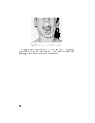 58
Fig. 6.9. Paciente anterior, a los 16 años de edad.
A esta paciente posteriormente se le realizó distracción osteogénica
monodireccional del lado afectado, en la cual quedó pendiente una
mentonoplastia de avance y rotación de la línea media.
 