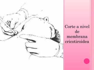 Corte a nivel
de
membrana
cricotiroidea

 