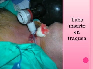 Tubo
inserto
en
traquea

 