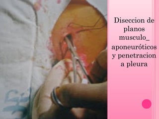 Diseccion de
planos
musculo_
aponeuróticos
y penetracion
a pleura

 