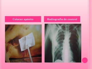Colocar apósito

Radiografía de control

 