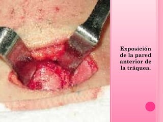 Exposición
de la pared
anterior de
la tráquea.

 