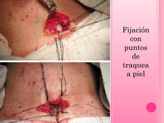 Fijación
con
puntos
de
traquea
a piel

 