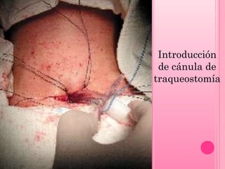 Introducción
de cánula de
traqueostomía

 