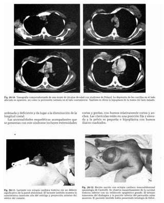 CLINICA QUIRURGICA - Cirugia pediatrica   ashcraft